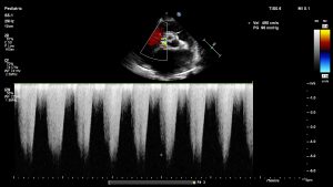 Adult 2D echo with GLS – SujyotHeartClinic