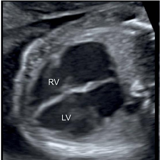 Fetal echo: Simplified 4 chamber view – SujyotHeartClinic