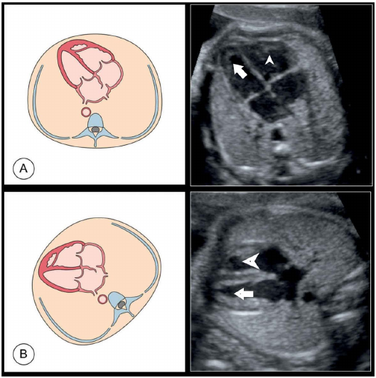 ECHO picture with hyperechoic moderator band in the right ventricle